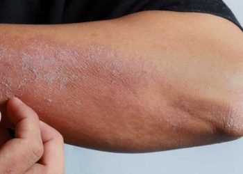 CBD bei Neurodermitis