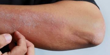 CBD bei Neurodermitis