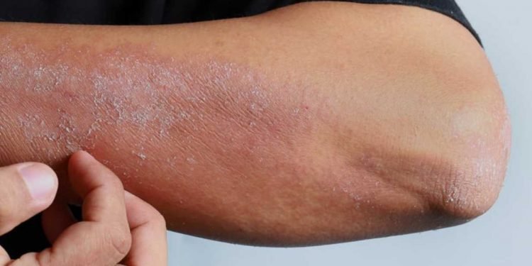 CBD bei Neurodermitis – Was kann das Öl? 16 CBD bei Neurodermitis